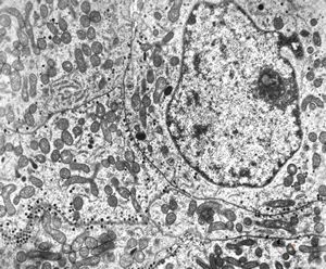 M,47y. | chromophobic pituitary adenoma M,47y. | chromophobic pituitary adenoma